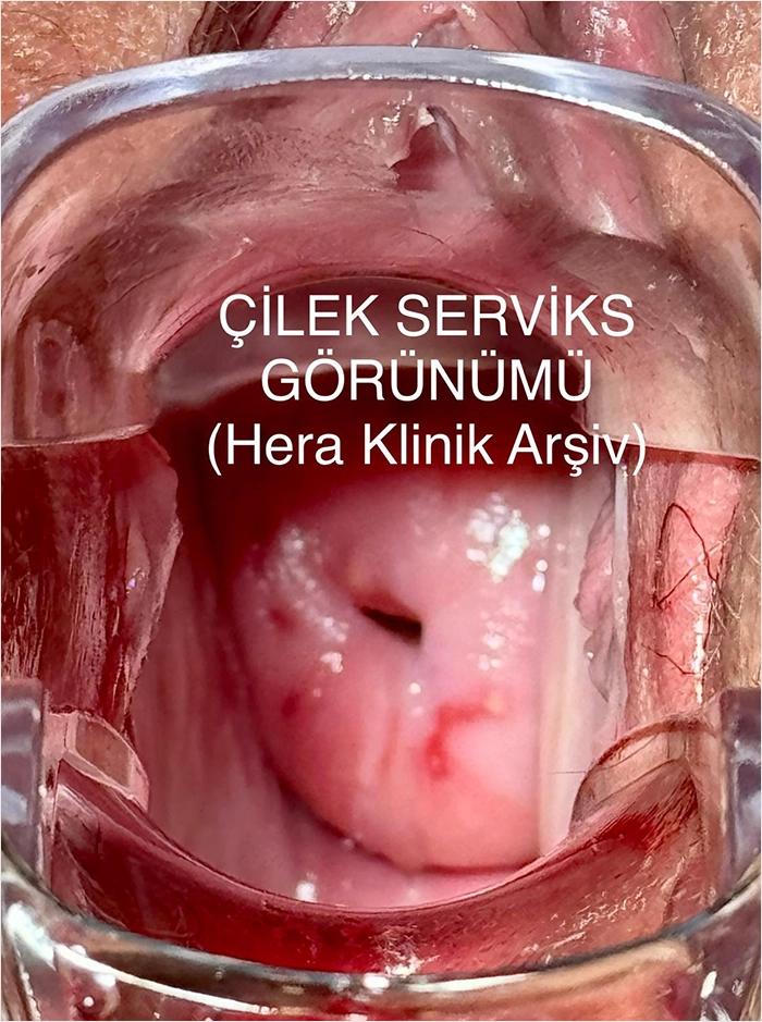 Çilek Serviks
