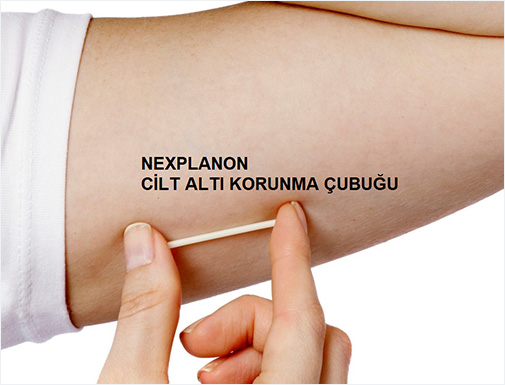 Deri Altı İmplant, Nexplanon Nedir?