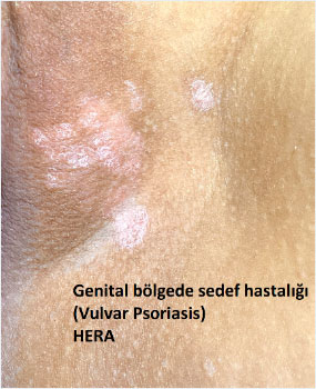 Genital bölgede sedef hastalığı (Vulvar Psöriasis)