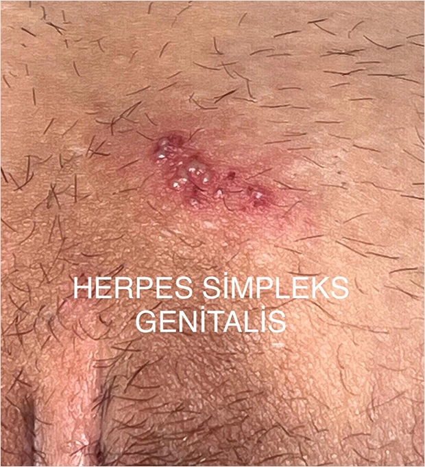 Genital Herpes
