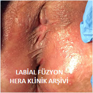 Labial Füzyon (Genital Dudaklarda Yapışıklık)