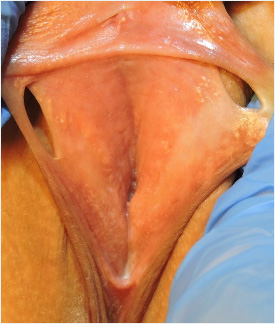 Labioplasti Sonrası Fenestrasyon