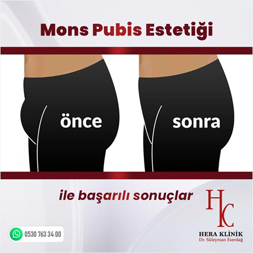 Mons Pubis Estetiği