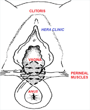 Perineoplasty Surgeries