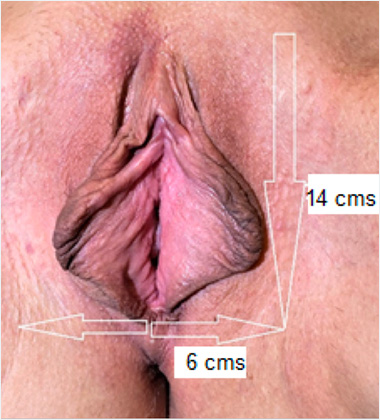 Vulva Picture